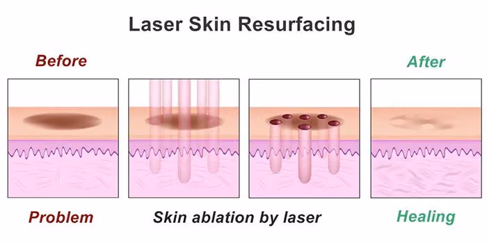 Laser skin resurfacing diagram showing a dark spot, laser ablation of the skin, and healed skin after