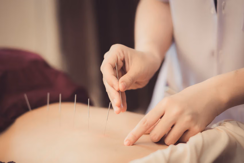 acupuncture